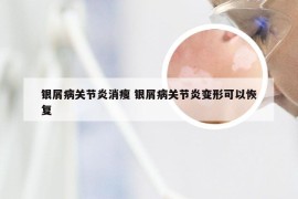 银屑病关节炎消瘦 银屑病关节炎变形可以恢复