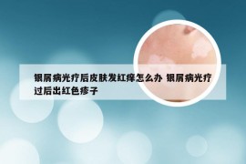 银屑病光疗后皮肤发红痒怎么办 银屑病光疗过后出红色疹子