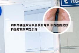四川华西医院治银屑病的专家 华西医院皮肤科治疗银屑病怎么样