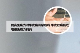 提高免疫力对牛皮癣有帮助吗 牛皮肤癣能吃增强免疫力的药