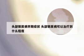 头部银屑病早期症状 头部银屑病可以治疗到什么程度