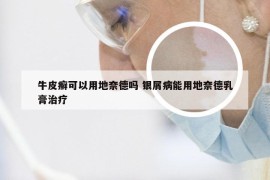 牛皮癣可以用地奈德吗 银屑病能用地奈德乳膏治疗