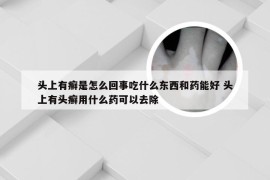 头上有癣是怎么回事吃什么东西和药能好 头上有头癣用什么药可以去除
