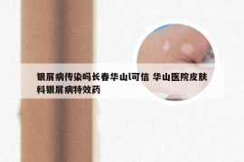 银屑病传染吗长春华山l可信 华山医院皮肤科银屑病特效药