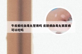 牛皮癣吃血毒丸管用吗 皮肤病血毒丸银屑病可以吃吗