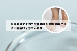 银屑病涂了卡泊三醇越来越大 银屑病用了卡泊三醇后好了怎么不复发