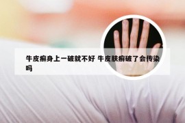牛皮癣身上一破就不好 牛皮肤癣破了会传染吗