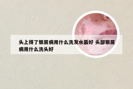 头上得了银屑病用什么洗发水最好 头部银屑病用什么洗头好