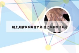 腿上,后背长癣用什么药 腿上长癣擦什么药