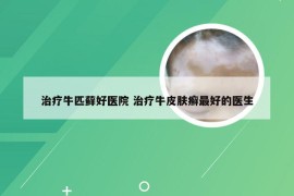 治疗牛匹藓好医院 治疗牛皮肤癣最好的医生
