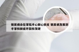 银屑病会在掌拓手心脚心脱皮 银屑病发展到手掌和脚底开裂和发硬