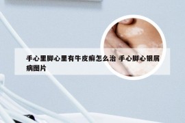 手心里脚心里有牛皮癣怎么治 手心脚心银屑病图片