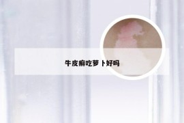 牛皮癣吃萝卜好吗