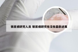 银屑病研究人员 银屑病研究有没有最新进展