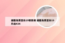 细胞角质蛋白19银屑病 细胞角质蛋白19片段434