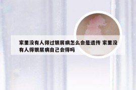 家里没有人得过银屑病怎么会是遗传 家里没有人得银屑病自己会得吗