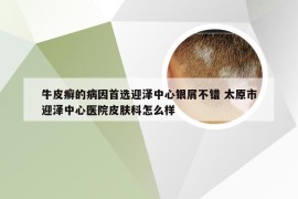 牛皮癣的病因首选迎泽中心银屑不错 太原市迎泽中心医院皮肤科怎么样