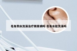 皂角熬水洗澡治疗银屑病吗 皂角水能洗澡吗