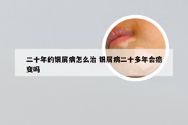 二十年的银屑病怎么治 银屑病二十多年会癌变吗