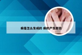 癣是怎么生成的 癣的产生原因