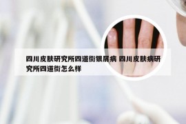 四川皮肤研究所四道街银屑病 四川皮肤病研究所四道街怎么样