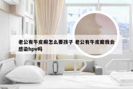 老公有牛皮癣怎么要孩子 老公有牛皮廨我会感染hpv吗