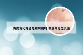 表皮角化亢进是银屑病吗 表皮角化怎么治