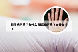 银屑病严重了会什么 银屑病严重了会什么样子