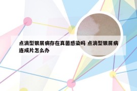 点滴型银屑病存在真菌感染吗 点滴型银屑病连成片怎么办