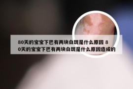 80天的宝宝下巴有两块白斑是什么原因 80天的宝宝下巴有两块白斑是什么原因造成的