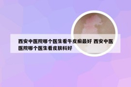 西安中医院哪个医生看牛皮癣最好 西安中医医院哪个医生看皮肤科好