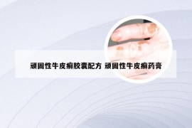 顽固性牛皮癣胶囊配方 顽固性牛皮癣药膏