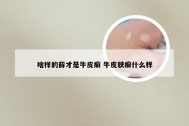 啥样的藓才是牛皮癣 牛皮肤癣什么样