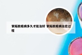 掌跖脓疱病多久才能治好 掌跖脓疱病治愈过程