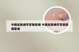 中国皮肤病学家银屑病 中国皮肤病学家银屑病是谁