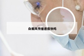 白癜风传播速度快吗