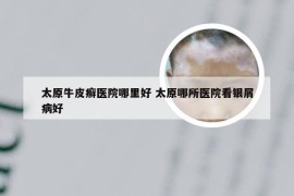 太原牛皮癣医院哪里好 太原哪所医院看银屑病好