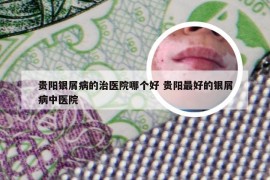 贵阳银屑病的治医院哪个好 贵阳最好的银屑病中医院