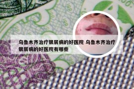 乌鲁木齐治疗银屑病的好医院 乌鲁木齐治疗银屑病的好医院有哪些