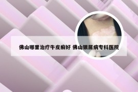 佛山哪里治疗牛皮癣好 佛山银屑病专科医院