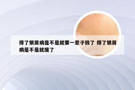 得了银屑病是不是就要一辈子毁了 得了银屑病是不是就废了