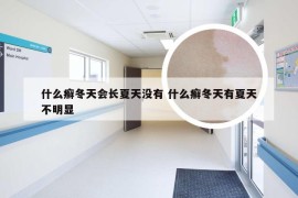 什么癣冬天会长夏天没有 什么癣冬天有夏天不明显