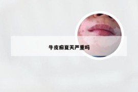 牛皮癣夏天严重吗