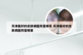 天津最好的皮肤病医院是哪家 天津最好的皮肤病医院是哪里