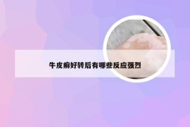 牛皮癣好转后有哪些反应强烈