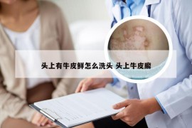 头上有牛皮鲜怎么洗头 头上牛皮廨