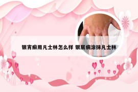 银宵癣用凡士林怎么样 银屑病涂抹凡士林