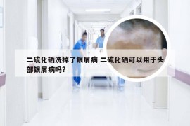 二硫化硒洗掉了银屑病 二硫化硒可以用于头部银屑病吗?
