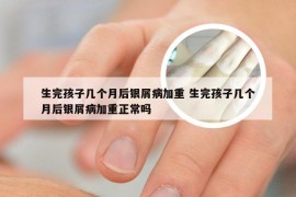 生完孩子几个月后银屑病加重 生完孩子几个月后银屑病加重正常吗