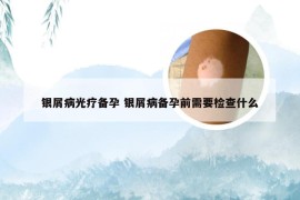 银屑病光疗备孕 银屑病备孕前需要检查什么